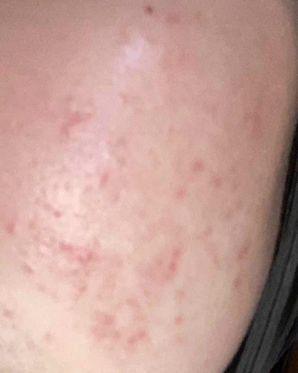 毛穴ちゃん on LIPS 「どうしたらこのニキビたちは消えてくれんでしょうか、、2年も戦い..」(3枚目)