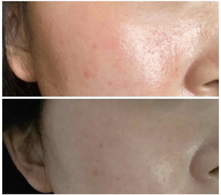 プリスクリードD(医薬品)/IHADA/その他を使ったクチコミ(1枚目)