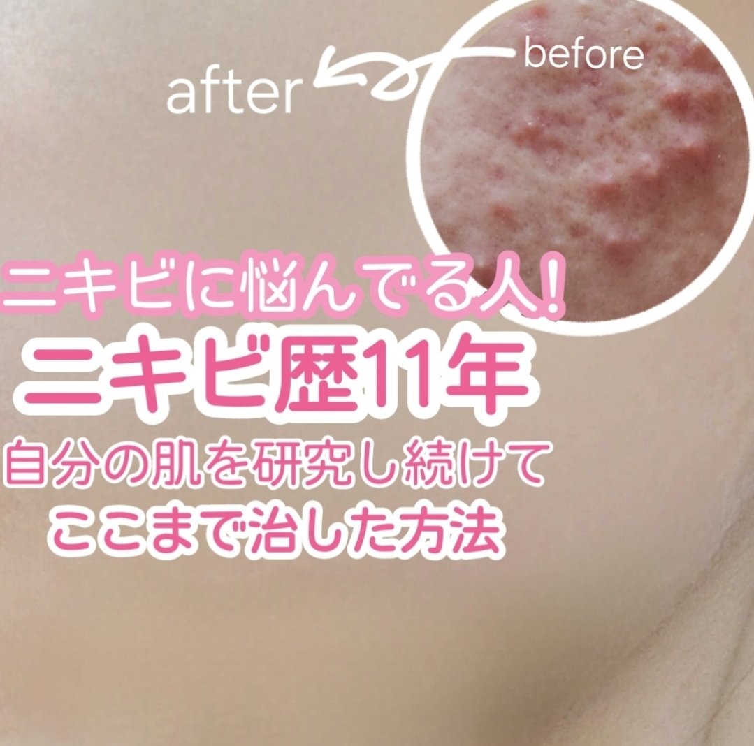 薬用パウダー化粧水/メンソレータム アクネス/化粧水を使ったクチコミ（1枚目）