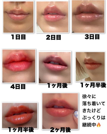 りっちゃん on LIPS 「やって良かった美容医療💉唇ヒアル💋/⚠️唇写真たくさん出ます昔..」(5枚目)