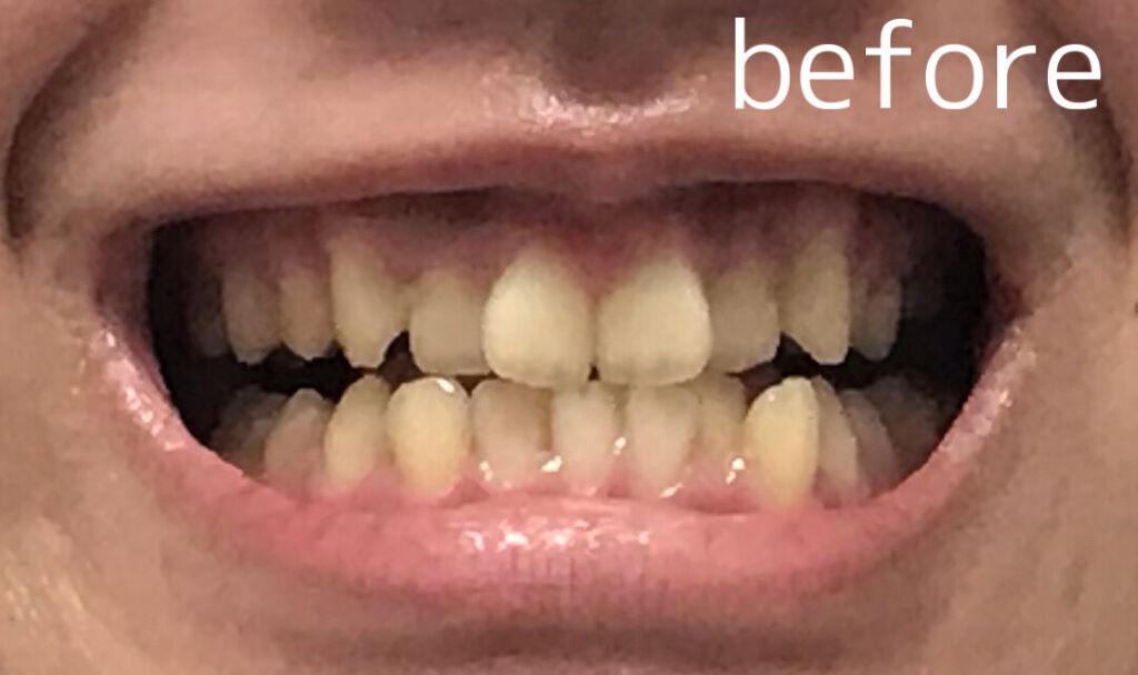 オーラツー プレミアム クレンジングペースト  プレミアムミント/オーラツー/歯磨き粉を使ったクチコミ（3枚目）