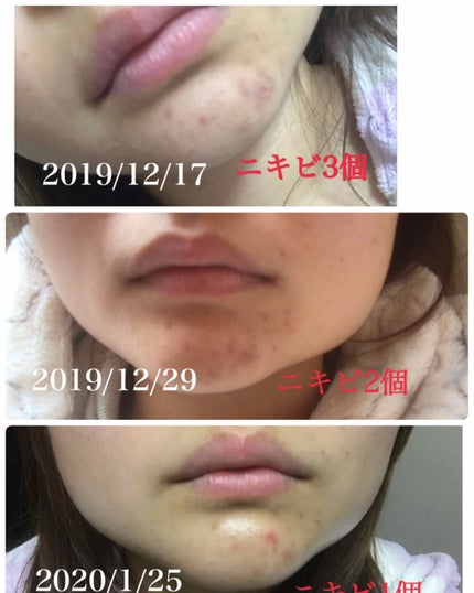 FDR アクネケア 化粧液/ファンケル/化粧水を使ったクチコミ(4枚目)