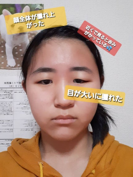 ベピオゲル/マルホ株式会社/その他を使ったクチコミ(2枚目)