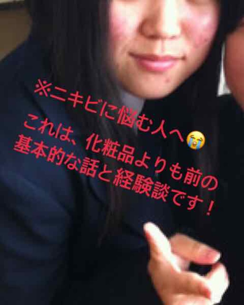 のら on LIPS 「初投稿です!いつも見る専ですが、ニキビに悩む人に、少しでも参考..」(1枚目)