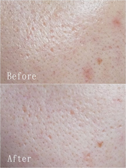 ビタペアC 集中美容液スペシャルセット/ネイチャーリパブリック/美容液を使ったクチコミ(2枚目)