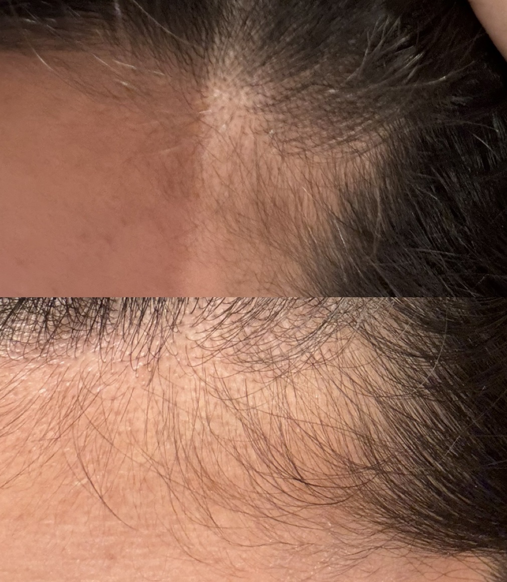 SonoRepro/アンファー(スカルプD)/ヘアケアグッズを使ったクチコミ（3枚目）