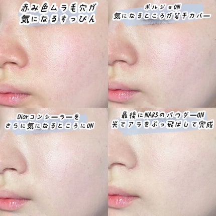 【旧】ディオールスキン フォーエヴァー スキン コレクト コンシーラー/Dior/リキッドコンシーラーを使ったクチコミ(5枚目)