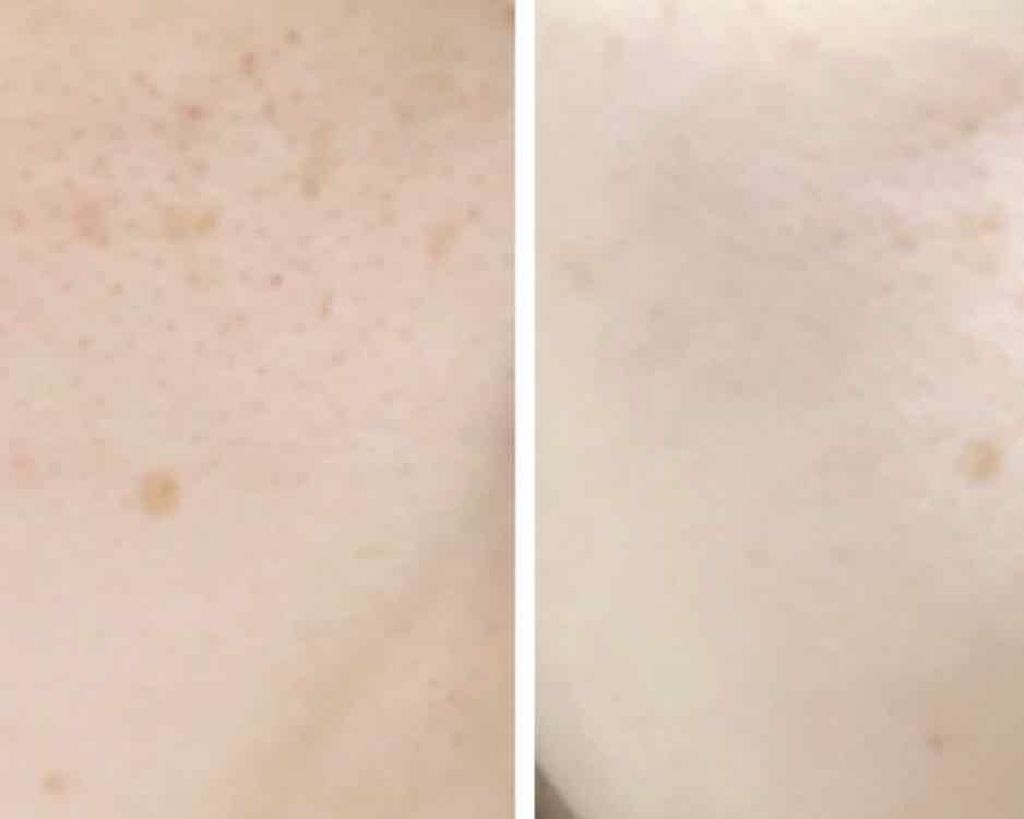 ブラン エクスペール メラノライザー AI アドバンスト/LANCOME/美容液を使ったクチコミ（3枚目）