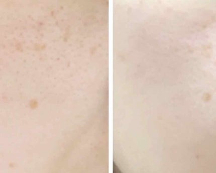 ブラン エクスペール メラノライザー AI アドバンスト/LANCOME/美容液を使ったクチコミ(3枚目)