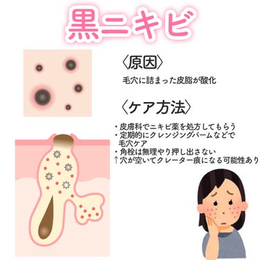 SENKA（専科） パーフェクトホイップ アクネケアのクチコミ「【保存推奨📎】ニキビ4タイプ別 原因とケア方法まとめ


ニキビは、進行度によって｢白ニキビ｣.....」（3枚目）