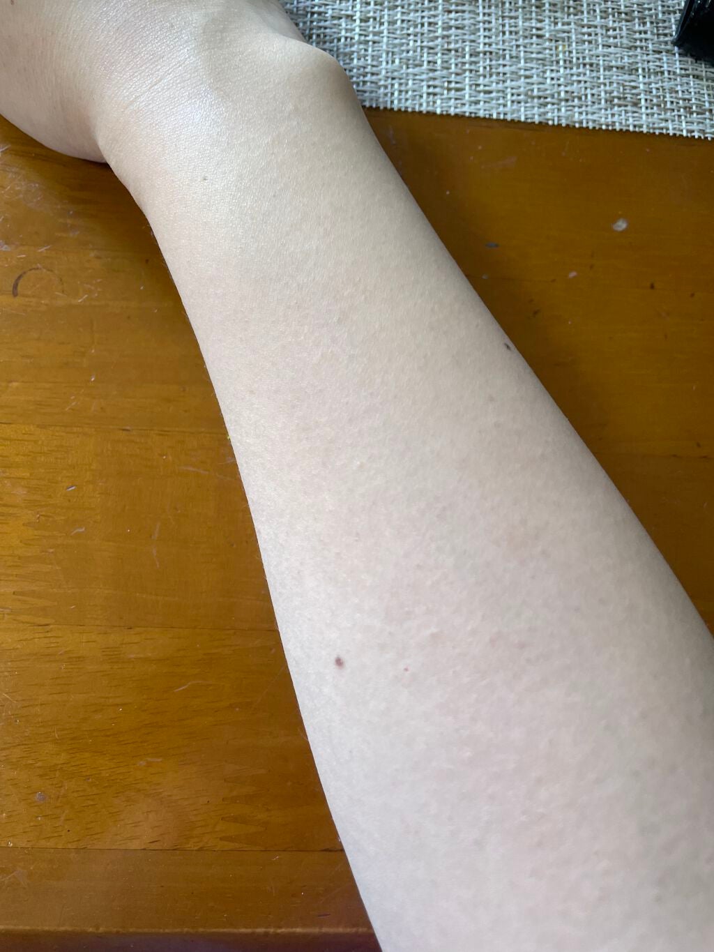 アイスレディ/icelady/家庭用脱毛器を使ったクチコミ(2枚目)