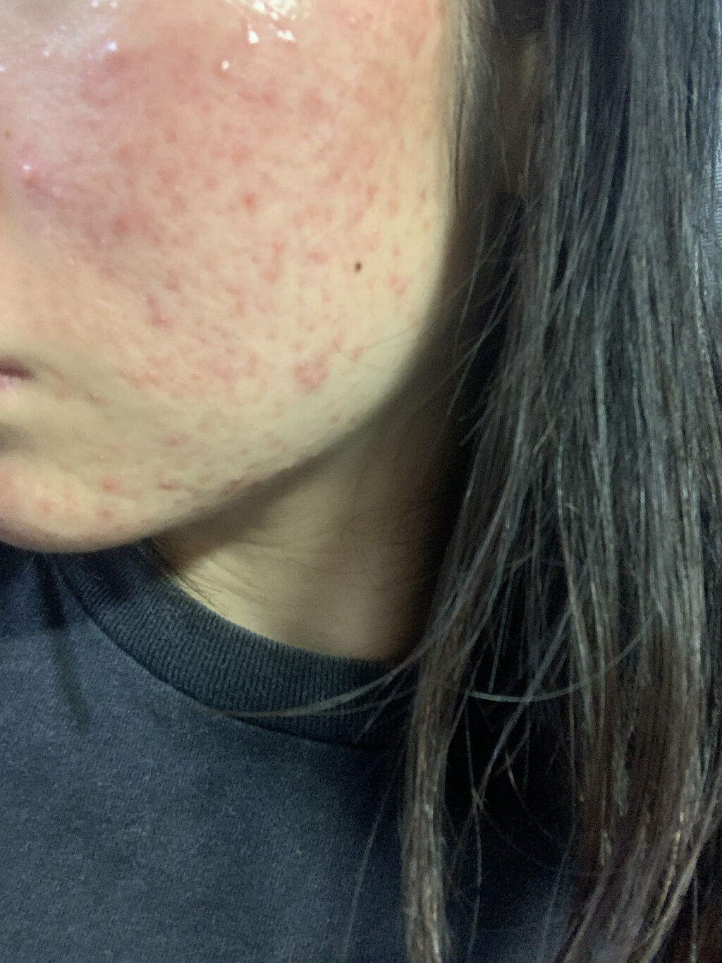 CHOI薬用マスク ニキビケア ［医薬部外品］/肌美精/シートマスク・パックを使ったクチコミ（3枚目）