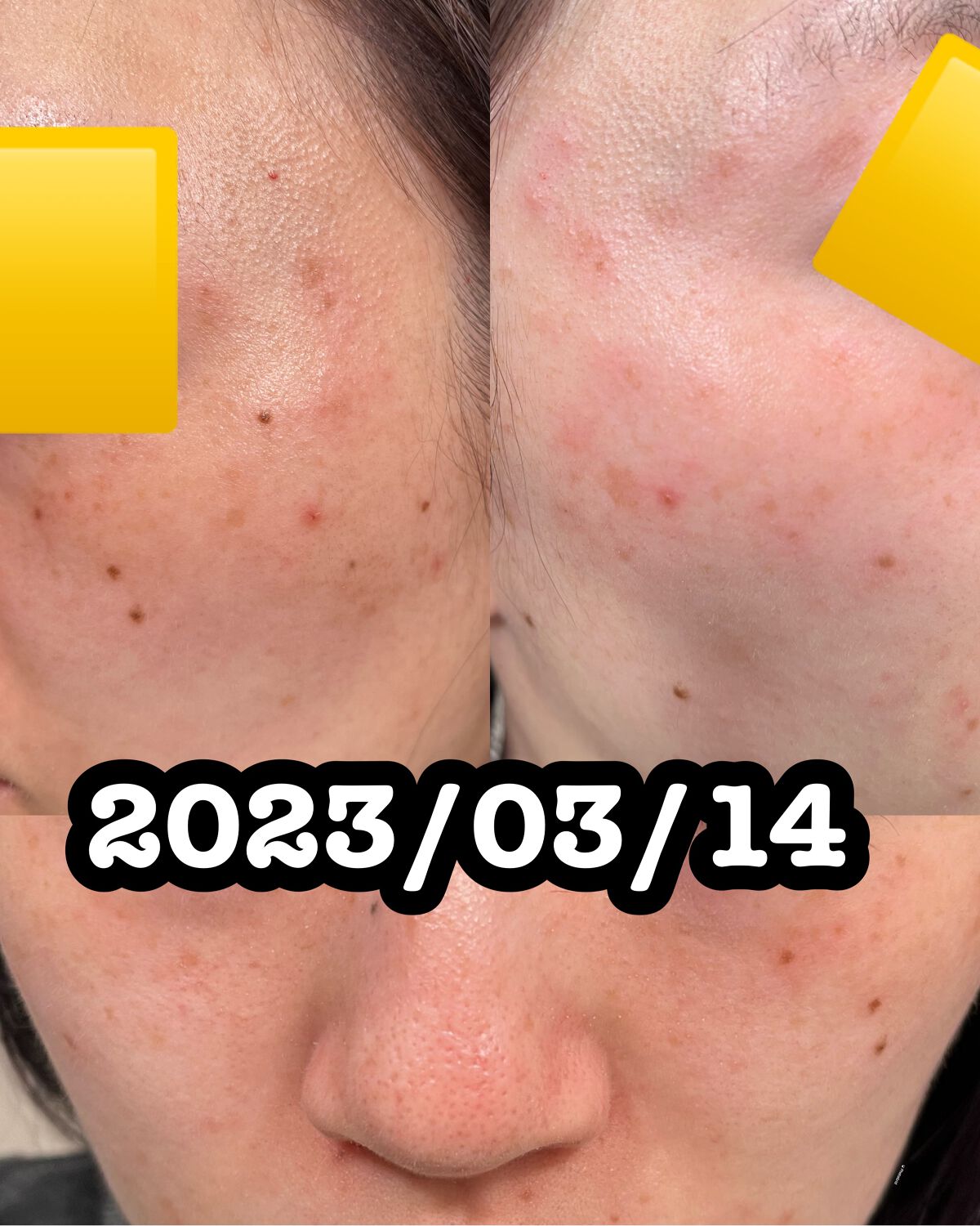 EUKROMA ハイドロキノンクリーム4% 20g/EUKROMA/その他スキンケアを使ったクチコミ(8枚目)