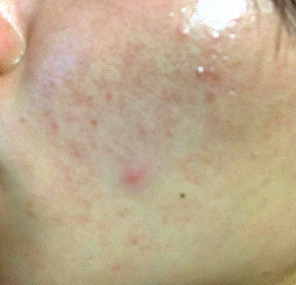 sou on LIPS 「ニキビ克服したい今日からスタート#はじめての投稿..」(1枚目)