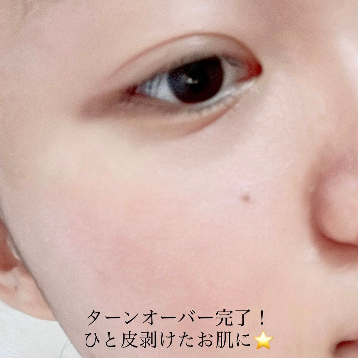 ダーマスキンピーリング/BQCELL/その他キットセットを使ったクチコミ(5枚目)