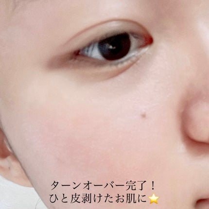 ダーマスキンピーリング/BQCELL/その他キットセットを使ったクチコミ(5枚目)