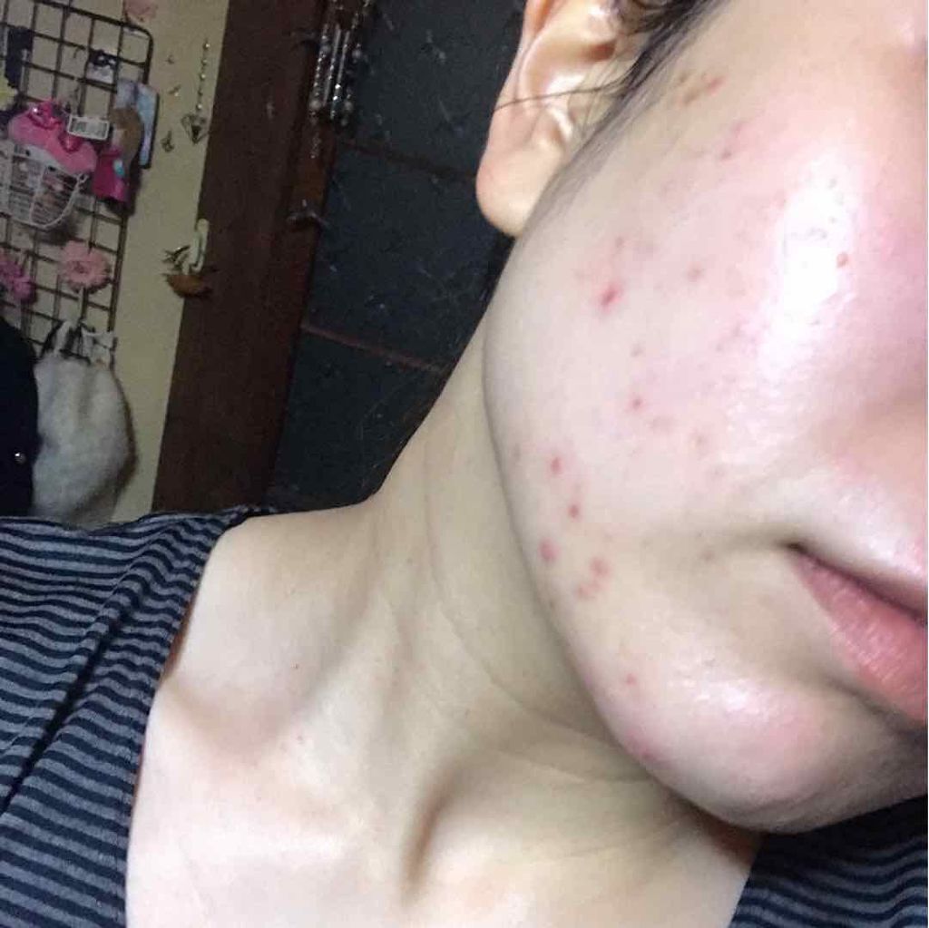 Rie❁❁ on LIPS 「2枚目ニキビの汚い画像あります*閲覧注意⚠です*ニキビの観察日..」(2枚目)