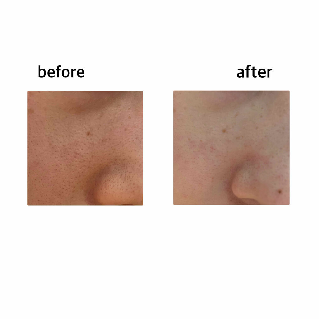 小鼻つるんっ/DAISO/その他スキンケアグッズを使ったクチコミ（3枚目）