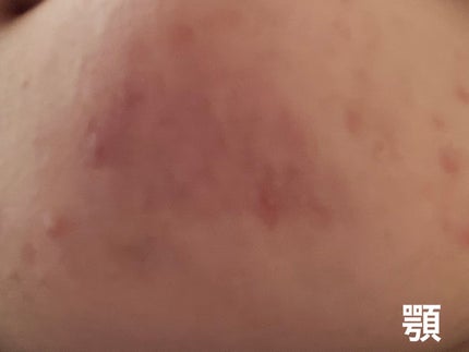 ニキビ治療薬(医薬品)/メンソレータム アクネス/その他を使ったクチコミ(4枚目)