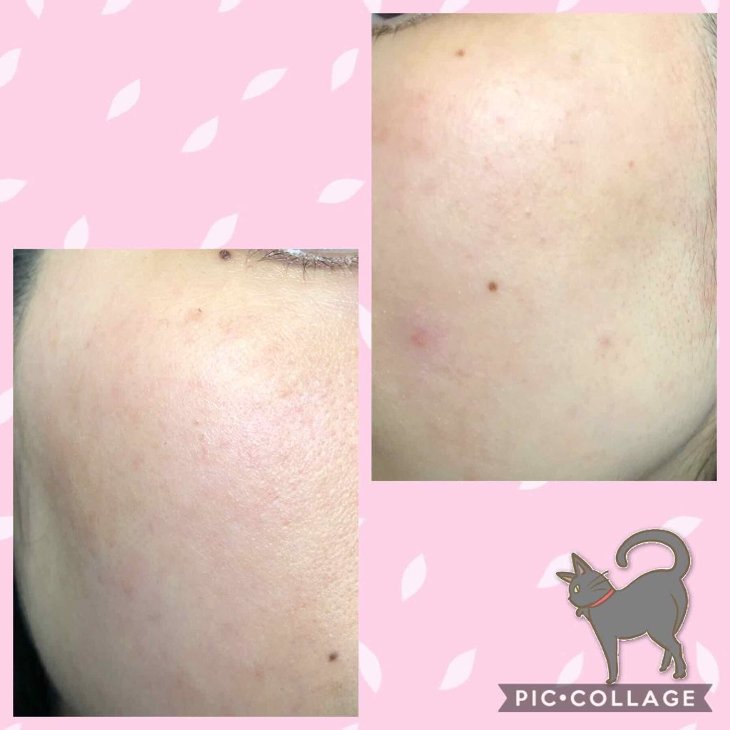 ねこになりたい。 on LIPS 「※2枚目に顔の画像あり!自分の肌荒れ日記。レビューじゃなくてす..」(2枚目)