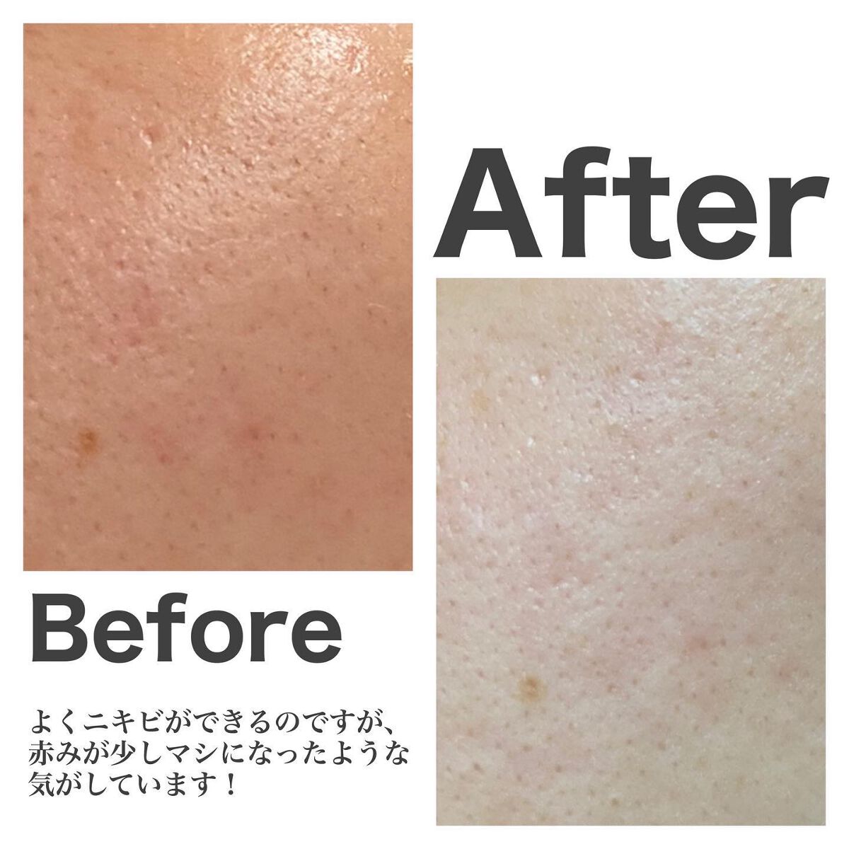 ニキビあとケアジェル/アットノン/その他スキンケアを使ったクチコミ（3枚目）