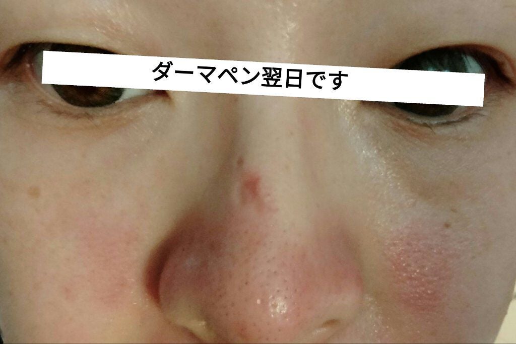 ダーマペン・ダーマスタンプ/MyM/その他スキンケアグッズを使ったクチコミ(2枚目)