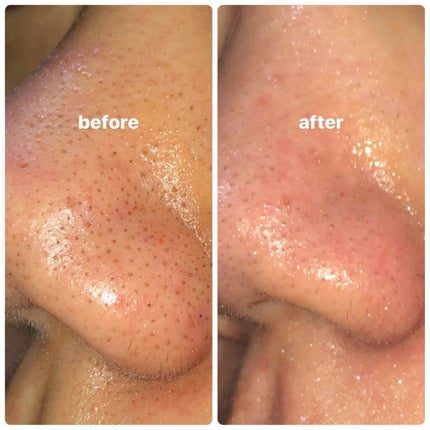 ツルリ 皮脂吸い出し 部分用パック ガスール&レッドパワー/ツルリ/洗い流すパック・マスクを使ったクチコミ(2枚目)