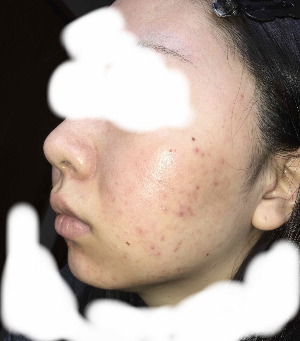 フワフワネコチャン on LIPS 「塗り始めて12日目(13日目朝)の写真です!昨日は忙しくて投稿..」(2枚目)