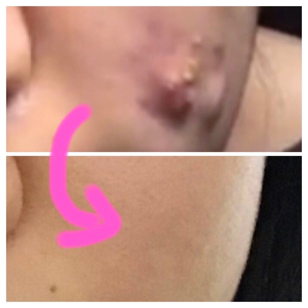 オードムーゲ 薬用ローション(ふきとり化粧水)/オードムーゲ/拭き取り化粧水を使ったクチコミ(2枚目)