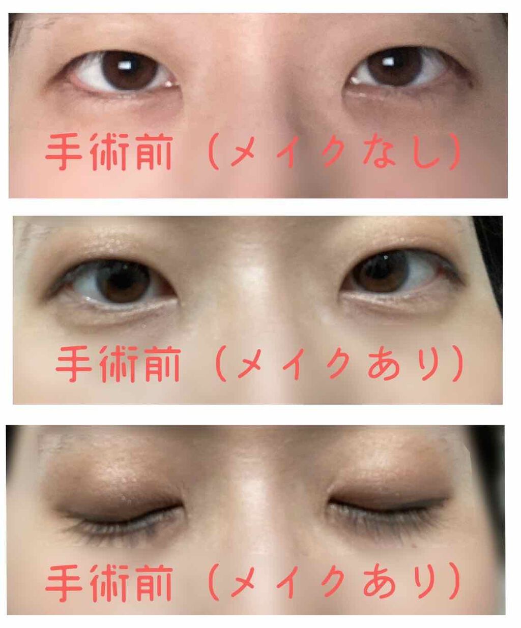 fantastic_blush_7x5 on LIPS 「本日、二重手術(小切開法・部分切開法)をしてきました。場所は兵..」(2枚目)