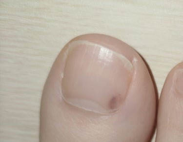 DAISO ガラス爪ヤスリのクチコミ「爪に見覚えのない黒いシミが？
ネットで調べてみるとメラノーマという文字が..

気になったので.....」（3枚目）