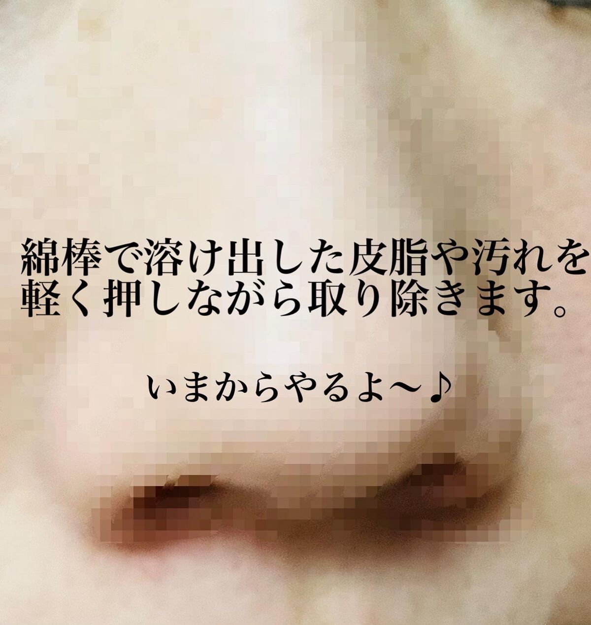 アクレオンセボエクストラクター/ANACIS/その他スキンケアを使ったクチコミ（3枚目）