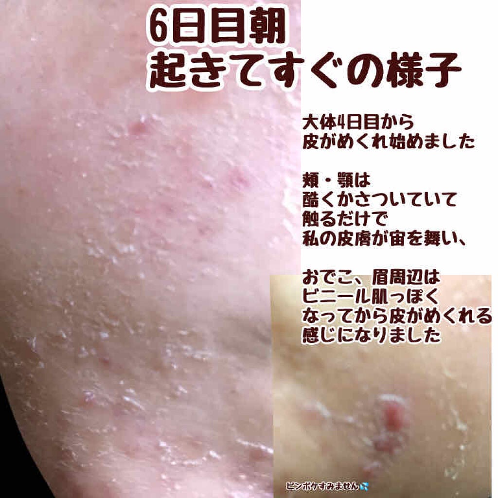 双海 on LIPS 「ニキビ治療期/皮膚科編⚡️Week1『皮膚科の先生助けてくださ..」(4枚目)