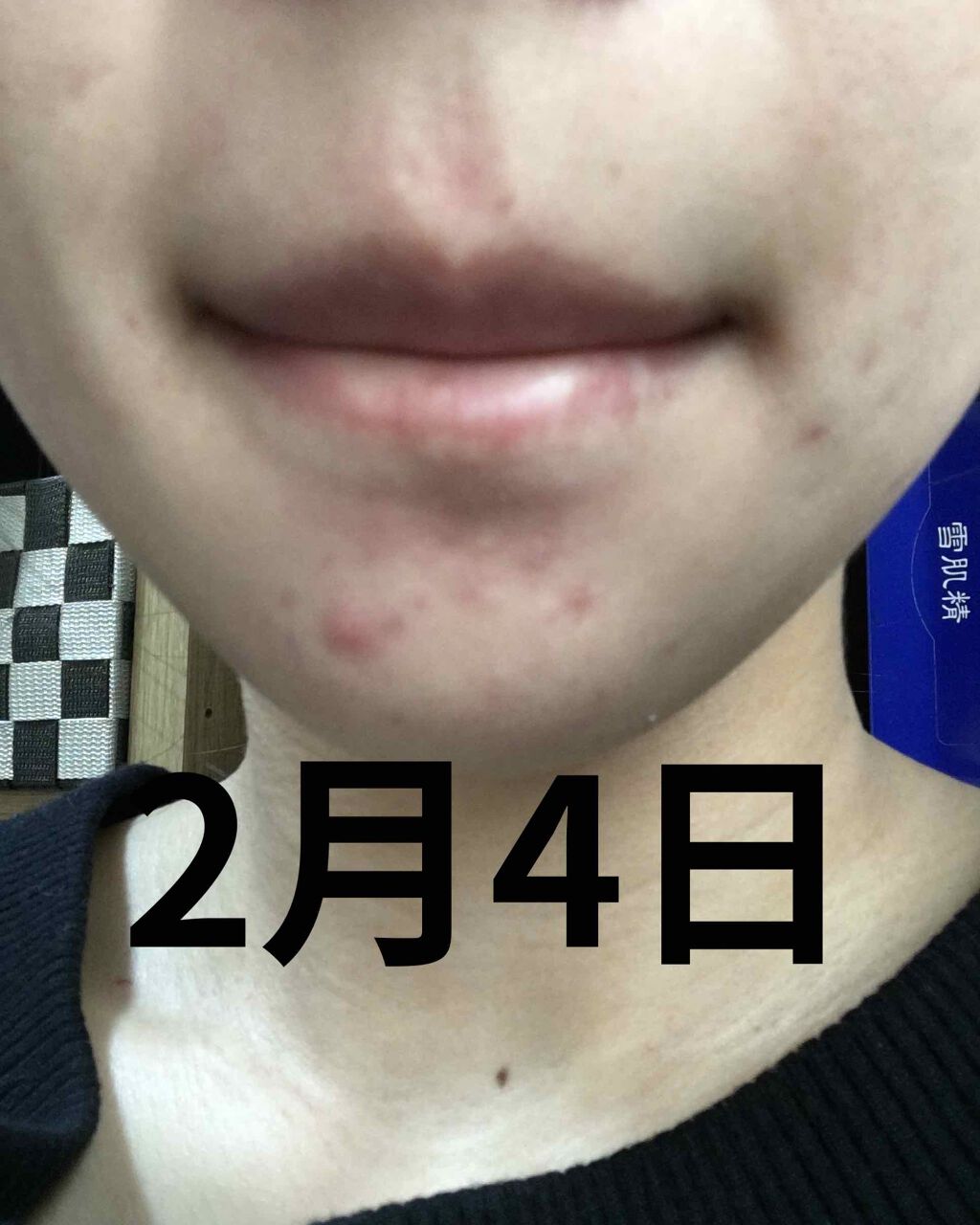 エピデュオゲル/マルホ株式会社/その他を使ったクチコミ（2枚目）