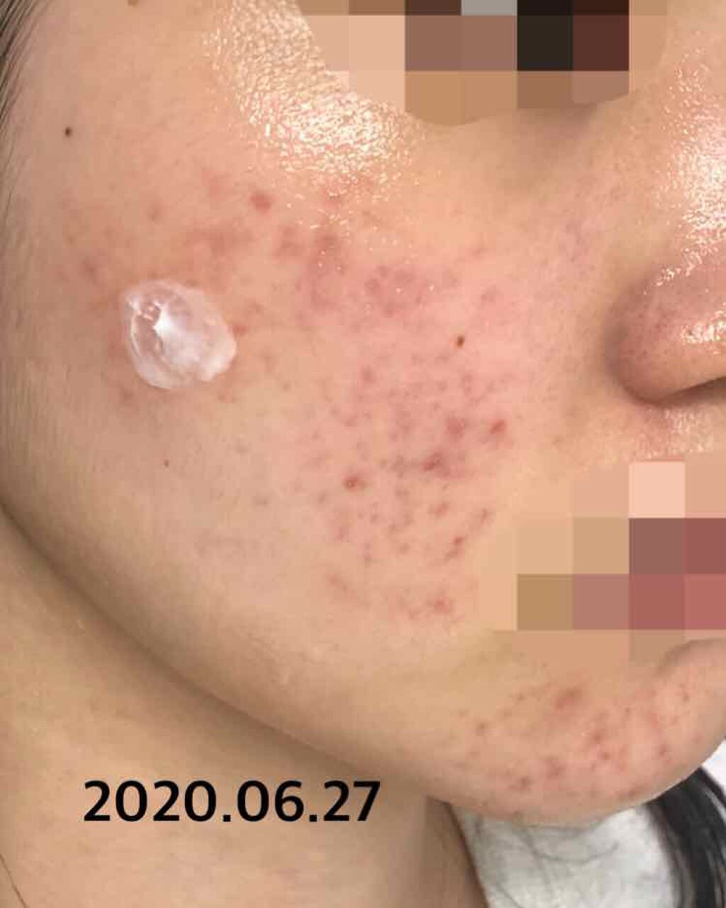 薬用 しみ 集中対策 美容液/メラノCC/美容液を使ったクチコミ（1枚目）