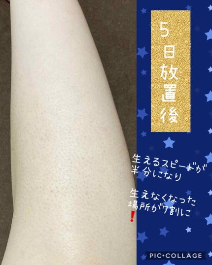 FASIZ607C IPL光脱毛器/FASIZ/家庭用脱毛器を使ったクチコミ(4枚目)