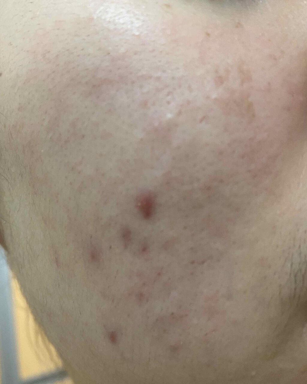 ACC パッチ/ETUDE/シートマスク・パックを使ったクチコミ(2枚目)