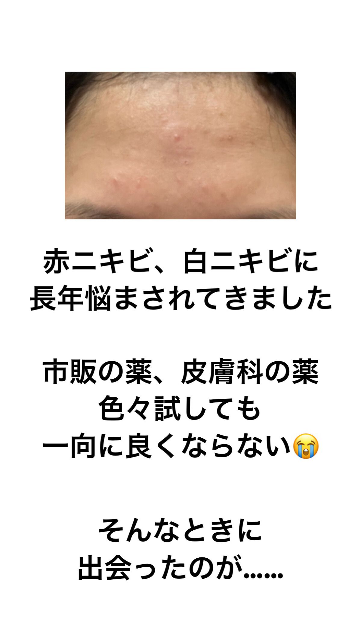 オロナインＨ軟膏 (医薬品)/オロナイン/その他を使ったクチコミ（3枚目）