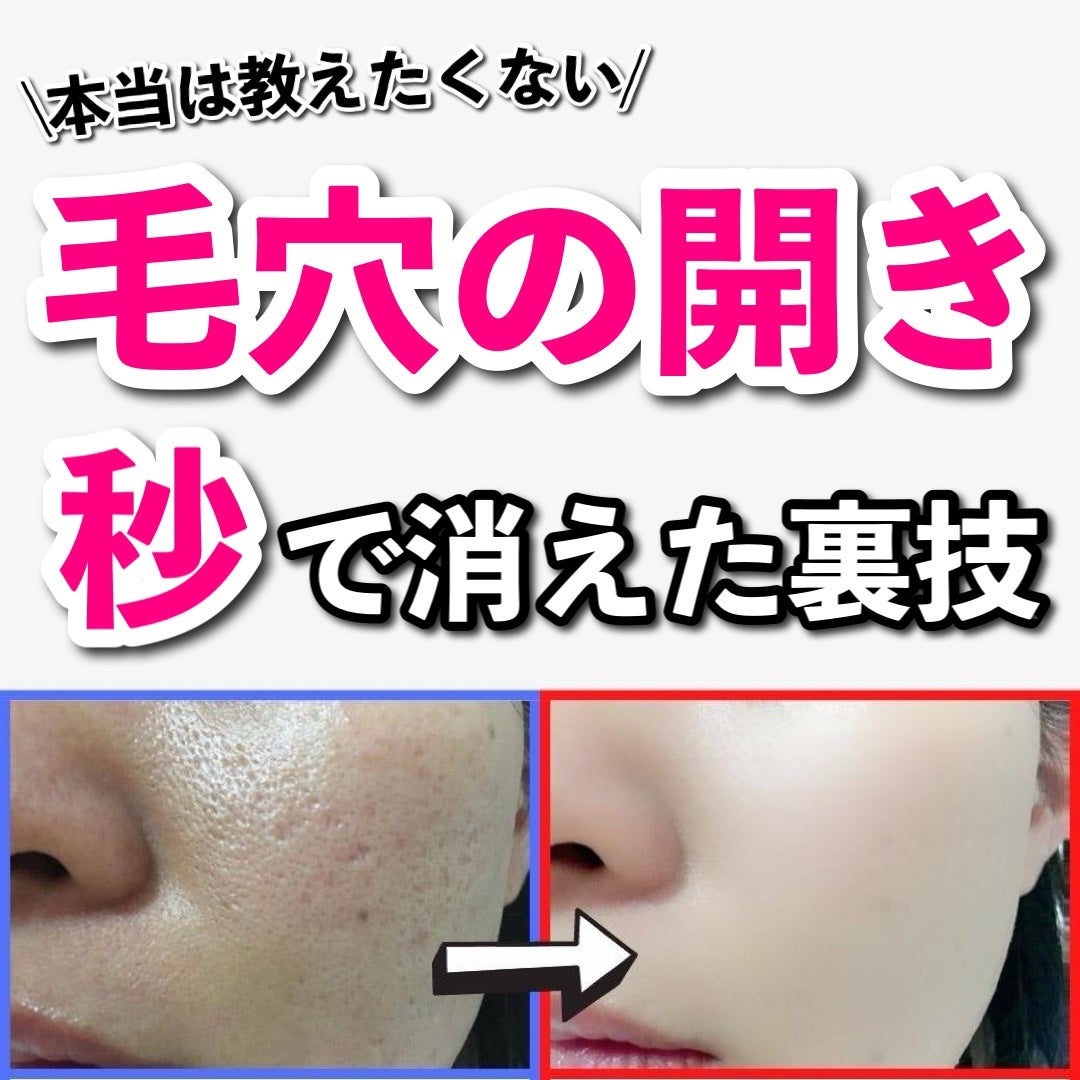 あなたの肌に合ったスキンケア💐コーくん先生 on LIPS 「【知らないと損】毛穴の開きが秒で消えた裏技がヤバすぎた......」(1枚目)