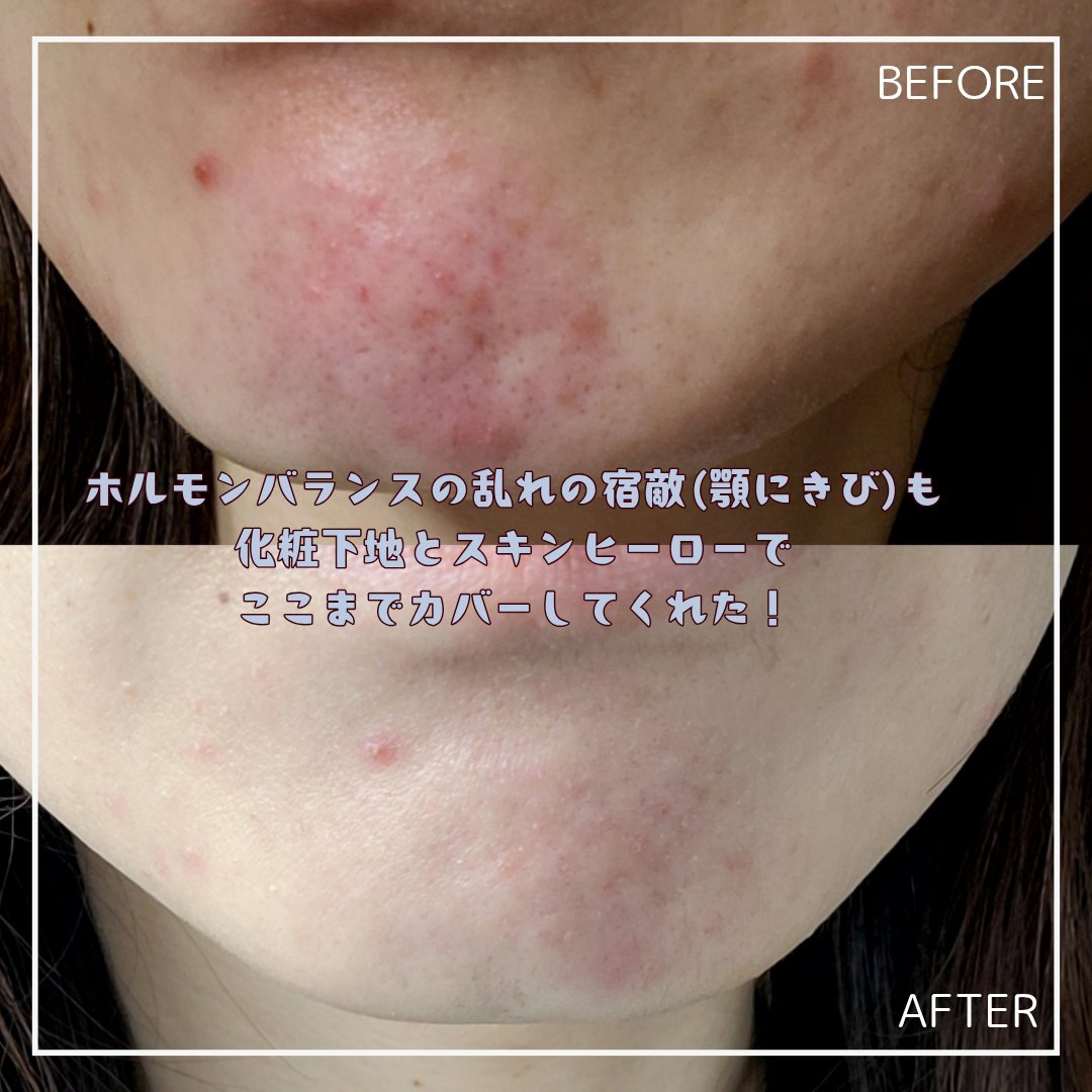 薬用スポットシーラークリーム/スキンヒーロー/クリームコンシーラーを使ったクチコミ（2枚目）