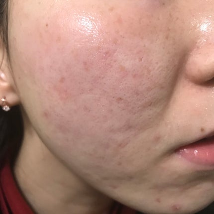 ティーツリーバイオーム ブレミッシュシカアンプル/MEDIHEAL/美容液を使ったクチコミ(1枚目)