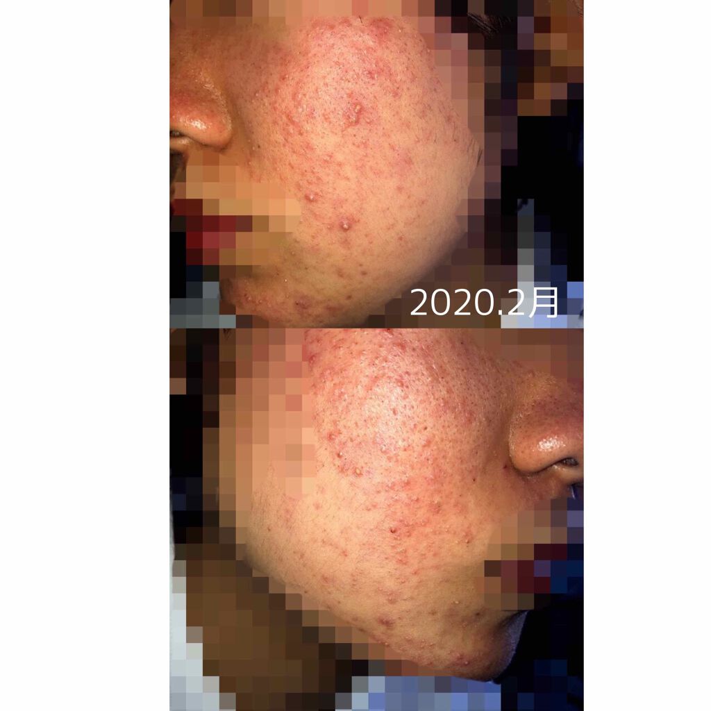 リンゴ酢/ミツカン/りんご酢を使ったクチコミ（3枚目）