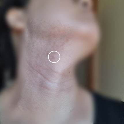 敏感肌な研究者💊あすか💊 on LIPS 「今回は首のニキビを治す最終段階で出来たニキビのそっくりさん(極..」(8枚目)