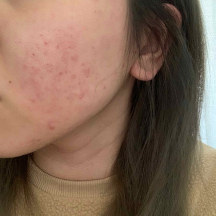 7 day Special Set プログラム3/b.glen/トライアルキットを使ったクチコミ(2枚目)