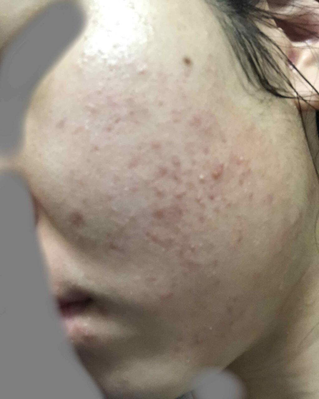 ベピオゲル/マルホ株式会社/その他を使ったクチコミ（2枚目）