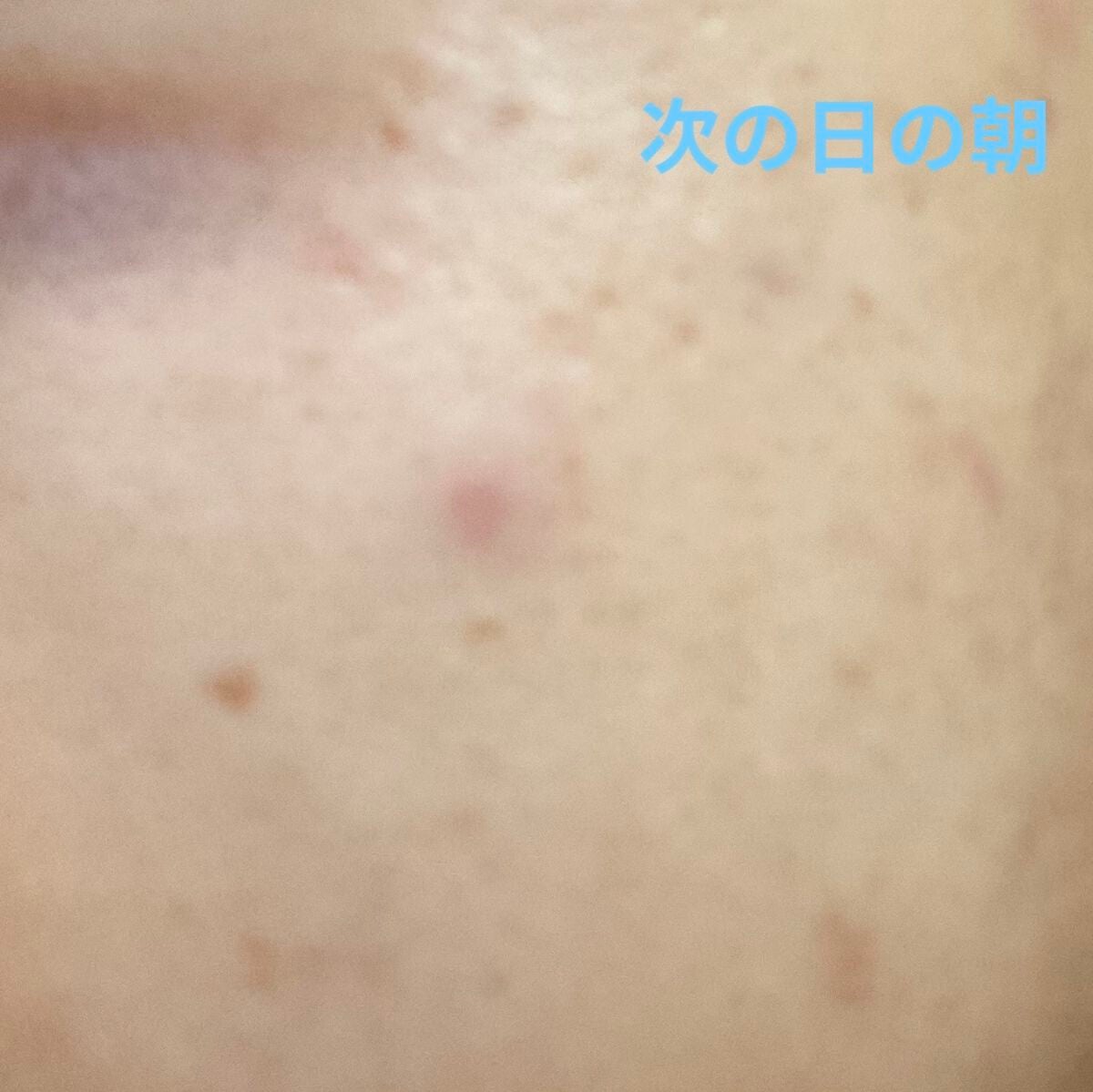 P.D.F A.Cドレッシングアンプルマスク EX/MEDIHEAL/シートマスク・パックを使ったクチコミ(6枚目)