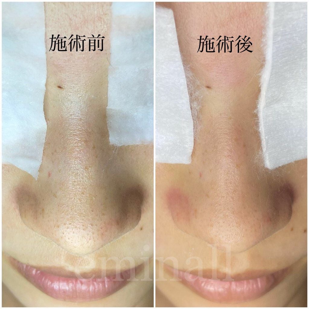 Haruka on LIPS 「毛穴エクストラクションを受けてきたビフォーアフターとレポを投稿..」(2枚目)