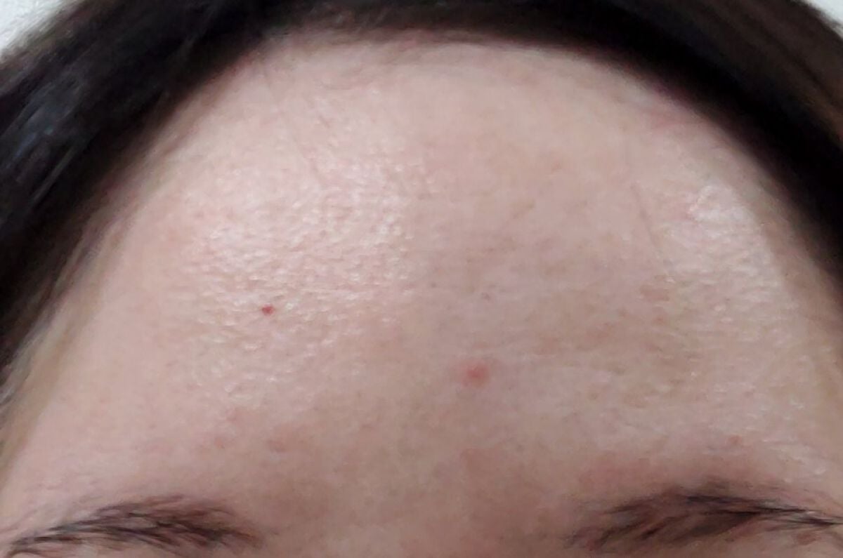 りま on LIPS 「ダーマペン4(ヴェルベットスキン)の経過観察3回目2022/9..」(2枚目)