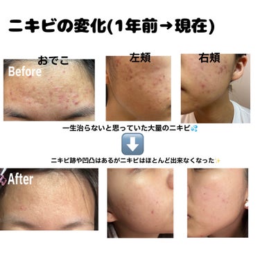 The Ordinary AHA 30% + BHA 2% Peeling Solutionのクチコミ「小学生から約10年続いたニキビを治すために気をつけたこと&スキンケア


💭.｡:･*ﾟ💫ﾟ*.....」（2枚目）