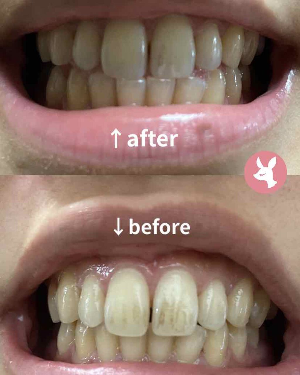 歯みがきペーストホワイト｜ルシェロの効果に関する口コミ「歯の黄ばみ